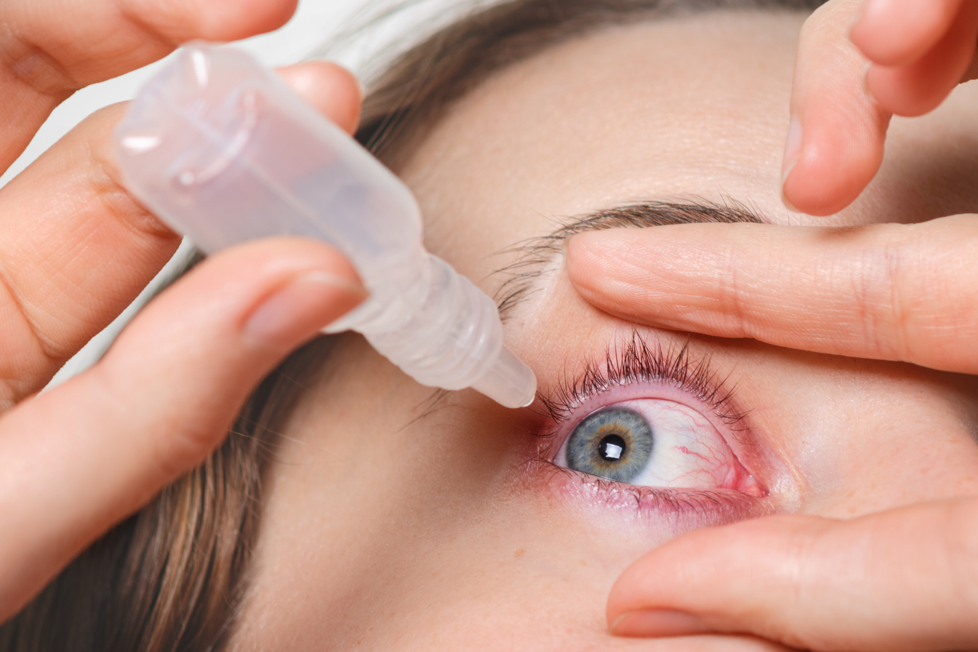 How to Get Rid of Puffy Eyes  Will Vision and Lasik Centers